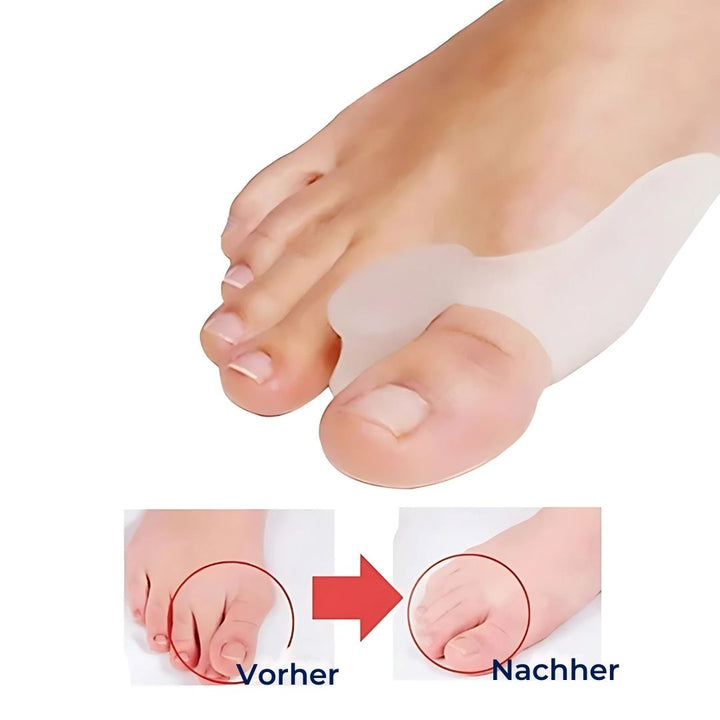 "BunionGuard Silikonschutz für Hallux Valgus, weiches Gel, lindert Schmerzen, korrigiert Zehenstellung, komfortabel"